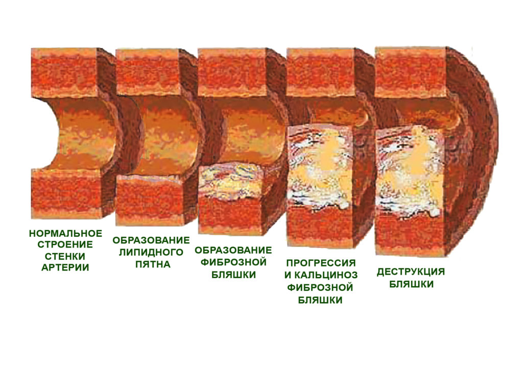 Стадии атеросклероза картинки