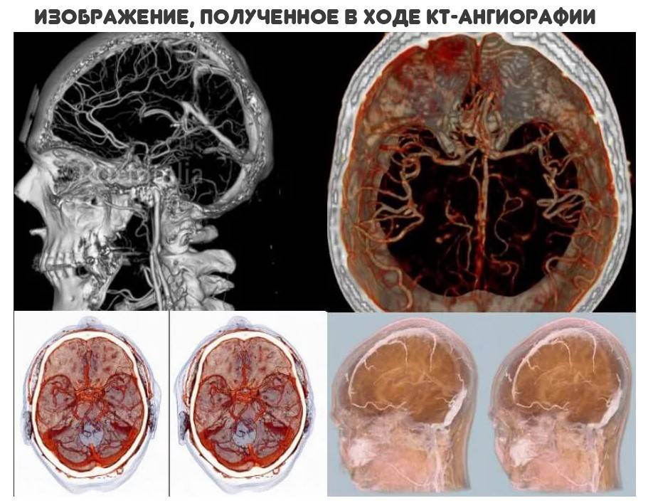 Патологии на мрт. Магнитно-резонансная ангиография головного мозга. Кт томограмма головного мозга. Кт ангиография сосудов головного мозга. Кт (компьютерная томография) сосудов головного мозга.