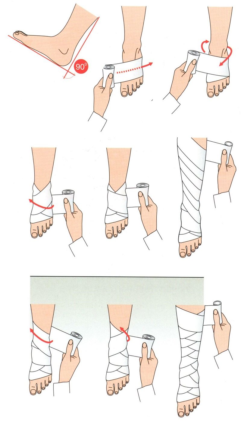 Как правильно бинтовать ноги после операции. Техника бинтования нижних конечностей. Техника бинтования эластичным бинтом голени. Техника эластичного бинтования нижних конечностей. Как правильно замотать Ступню эластичным бинтом.