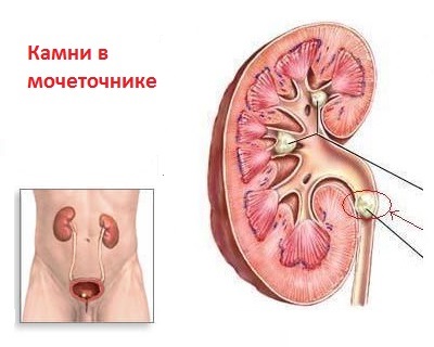 Что делать если камень застрял в мочеточнике. Камень в мочеточнике у мужчин. Конкремент мочеточника. Камни в мочеточнике и мочевом пузыре. Камни в моче точнтке.