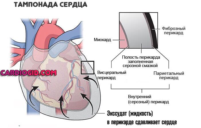 Скопление воздуха в перикарде латынь. Гидроперикард тампонада сердца. Полости перикарда (гидроперикард. Перикардит и тампонада сердца. Перикард (околосердечная сумка).