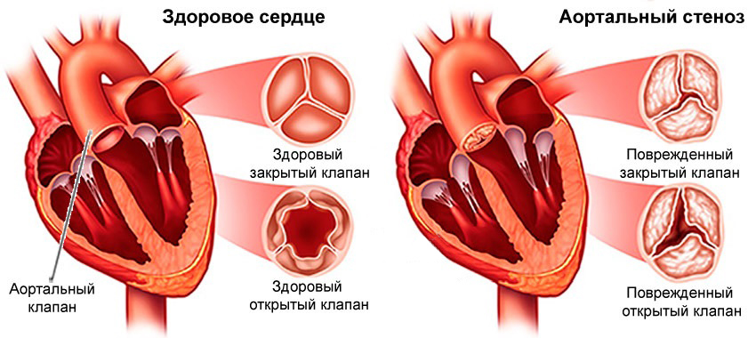 Аортальный стеноз картинки