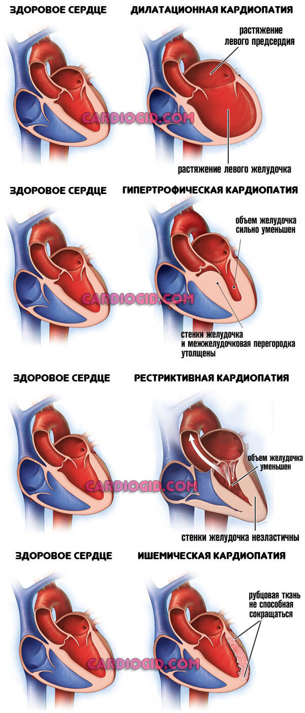 Кардиопатия. Кардиопатия сердца симптомы. Дилатационная кардиомиопатия сердца. Заболевания сердца кардиомиопатии.