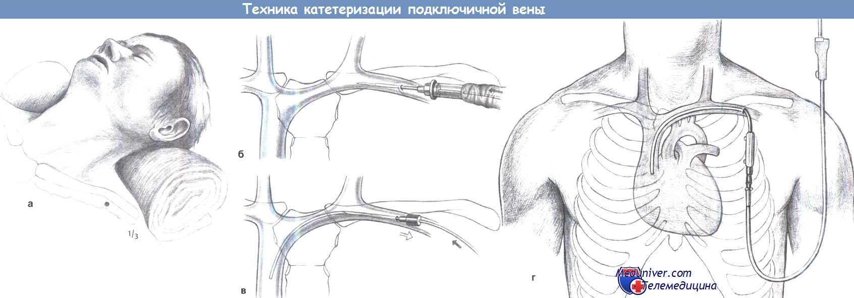 Рисунок подключичной вены