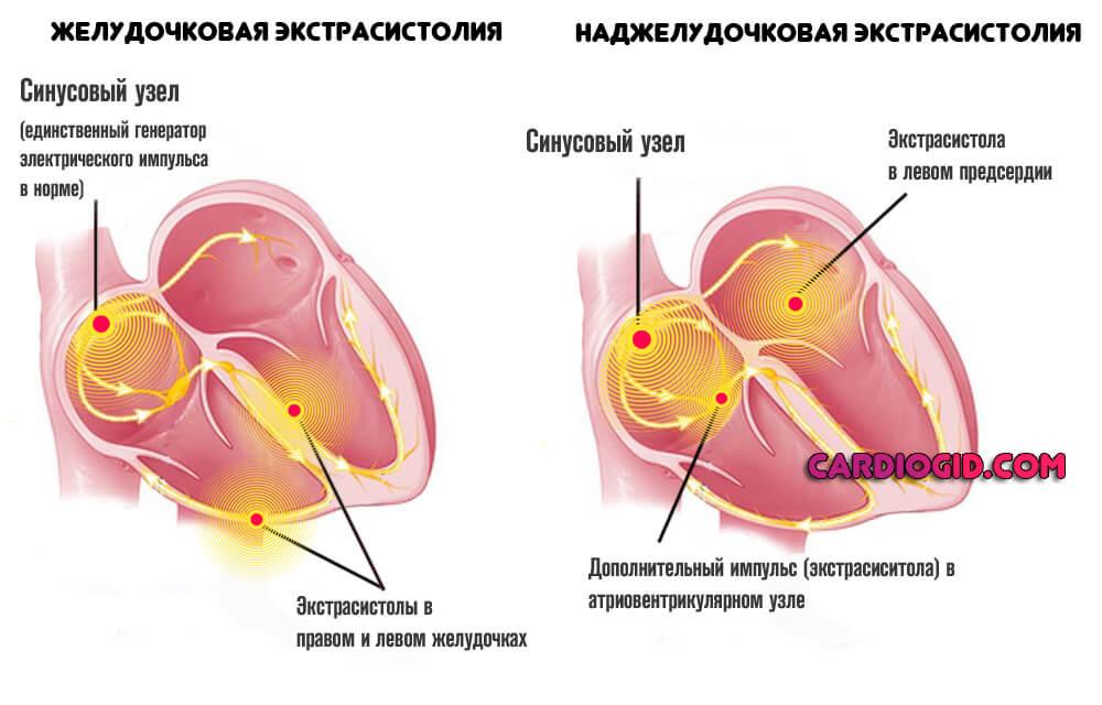 Нормальное сердце. Наджелудочковая экстрасистолия сердце. Инфаркт миокарда с экстрасистолами. Наджелудочковый гребень.