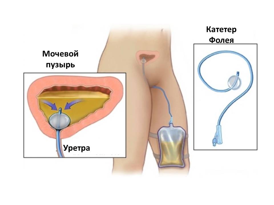 Несостоятельность цистостомы карта смп