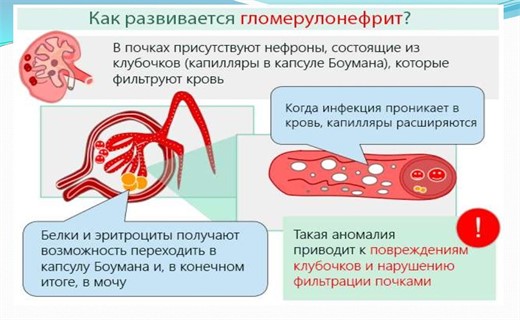 Гломерулонефрит карта вызова