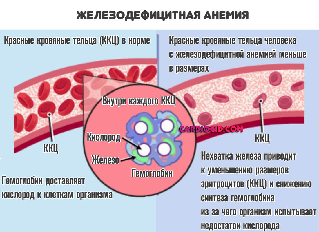 Лечение железодефицитной анемии картинки