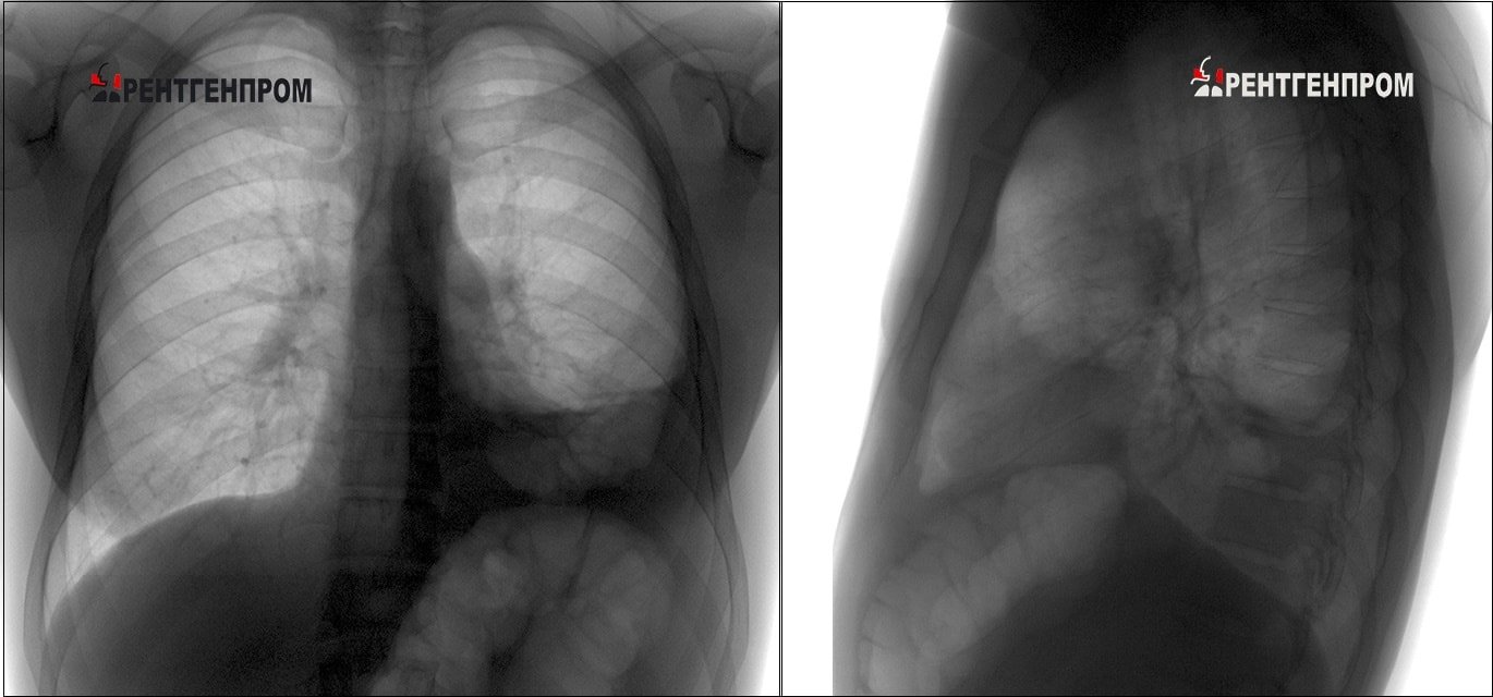Снимок флюорографии здорового человека фото